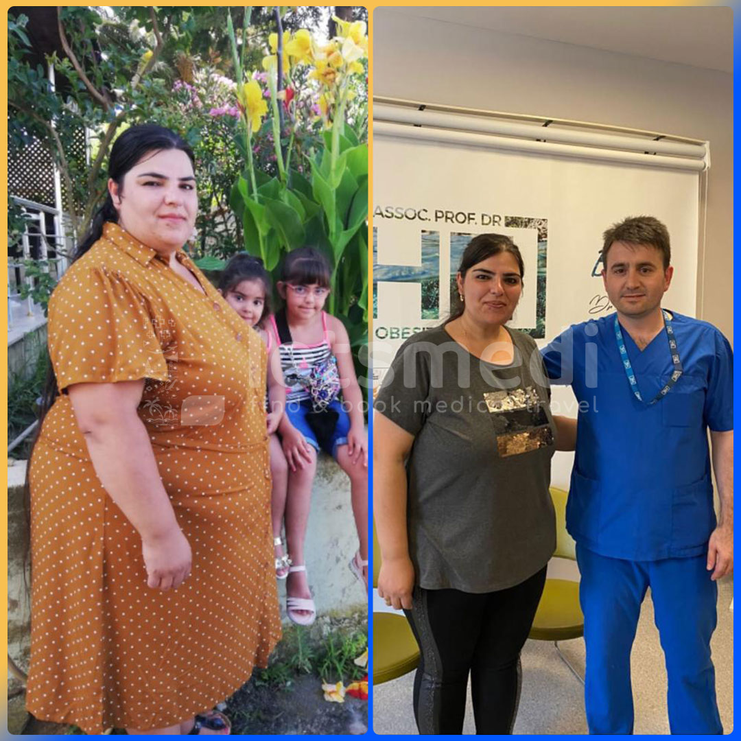 Before and after gastric sleeve in Turkey